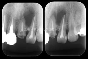 嚢胞 治療 歯根 ただの虫歯が歯根嚢胞に！顎の骨を削り、3本抜歯した治療体験談！｜体調不良ドットコム